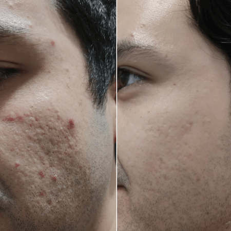 Microneedling before and after example 1