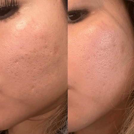 Microneedling before and after example 2