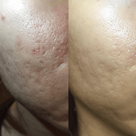 Microneedling before and after example 3