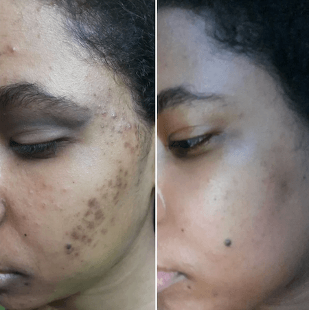 Microneedling before and after example 4