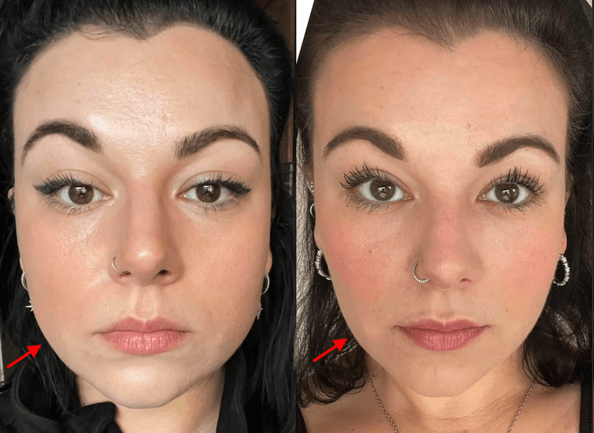 Before and after photos showing masseter botox results (example 1)