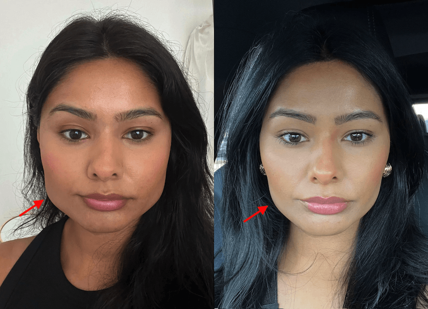 Before and after photos showing masseter botox results (example 3)